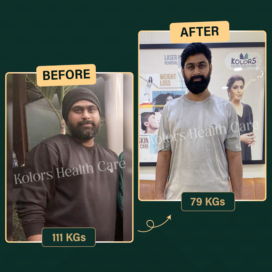 Vikram R. before and after weight loss: 111 kgs to 79 kgs